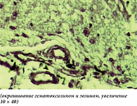 Рис. 4. В непосредственно прилежащих к зонам ишемии областях мозга отмечается периваскулярный и перицеллюлярный отек