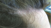 Рис. 7. Пациент Ж. через четыре недели после второй инъекции устекинумаба. Отсутствие псориатических высыпаний на волосистой части головы