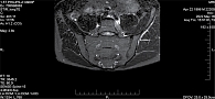 Рис. 2. Магнитно-резонансная томограмма КПС пациента К. в режиме STIR через 6,5 месяца (очаги активного костномозгового отека (остеита) в области суставов не определяются)