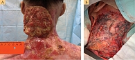 Рис. 6. А – прогрессирование очага плоскоклеточного рака кожи заднебоковой поверхности шеи слева; Б – удаление новообразования кожи с пластикой расщепленным свободным кожным лоскутом