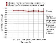 Рис. 1. Тональная пороговая аудиограмма. Пороги воздушной звукопроводимости с обеих сторон в пределах физиологической нормы (0–10 дБ HL) на частотах 125–8000 Гц. Заключение: слуховая функция в пределах нормы
