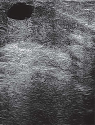 Рис. 14. УЗ-картина кисты правой молочной железы у 17-летней пациентки