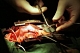 Применение пирибедила (Пронорана) у пациентов с ишемической болезнью сердца, подвергшихся операции коронарного шунтирования в условиях искусственного кровообращения