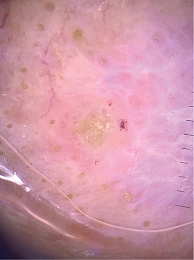 Рис. 6. Неполяризованная дерматоскопия: корка желтоватого цвета, мелкие древовидные сосуды по ее краю, белесоватая бесструктурная область, соответствующая рубцу