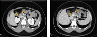 Рис. 5. Пациент М., 20 лет. Компьютерная томография органов брюшной полости. Аксиальная плоскость, венозная фаза: картина количественной лимфаденопатии в брюшной полости и в малом тазу; признаки жировой дегенерации поджелудочной железы
