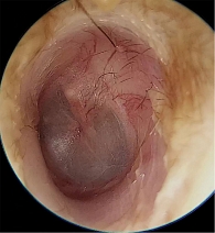 Рис. 3. Отоэндоскопия левого уха на седьмой день от начала консервативного лечения