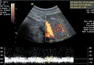 Рис. 13. Венозный кровоток в мелких артериях поджелудочной железы (режим энергетического картирования и импульсной допплерометрии)