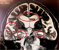 Рис. 3. МРТ пациента с синдромом БА-иНТГ. Сочетание признаков расширения желудочковой системы мозга (височных рогов боковых желудочков) при выраженной атрофии медиобазальных отделов височных долей мозга. Угол мозолистого тела 122,9°