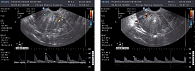 Рисунки 5, 6. Изменение IR в маточных артериях и эндометриоидных гетеротопиях на фоне лечения