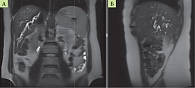 Рис. 3. Магнитно-резонансная томография брюшной полости,  Т2-взвешенные изображения: А – фронтальная плоскость;  Б – сагиттальная плоскость. Определяется расширение внутрипеченочных желчных протоков печени с наличием мелких гипоинтенсивных включений в про