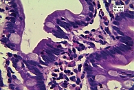 Рис. 3. Гистологическое исследование биоптатов ДПК: инфильтрация эозинофилами эпителия ворсин (превышает 70 в поле зрения при увеличении × 774,0). Окраска гематоксилином и эозином