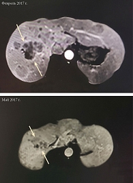 Магнитно-резонансная томография брюшной полости: динамика уменьшения метастатических очагов