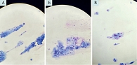 Рис. 11. Мазки-отпечатки под микроскопом на день 7 ± 1: А – пациента первой группы, Б – пациента второй группы, В – пациента третьей группы