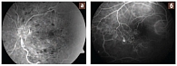Рис. 3. Ангиографическая картина глазного дна. Окклюзия центральной вены сетчатки (ЦВС), неишемический тип (а). Окклюзия ветви ЦВС, ишемический тип (б)