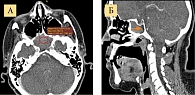Рис. 4. КТ ОНП с искусственным внутривенным контрастированием: аксиальная (А) и сагиттальная (Б) плоскости