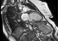 Рис. 2. Магнитно-резонансная томография сердца с внутривенным контрастированием на момент поступления: фиброз миокарда левого желудочка в базальных, средних и верхушечных отделах