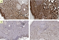 Рис. 4. Иммуногистохимическое исследование у пациентки С.  до и после лазерной терапии (А – коллаген I типа, Б – коллаген III типа)