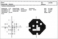 Рис. 7. iVA. 24–2. Пациент 2, левый глаз: концентрическое сужение поля зрения с сохранением единичных островков