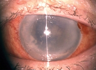 Рис. 1. Экссудация, образование фибринозно-гнойных мембран