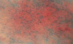 Рис. 3. Микроэндоскопическая картина слизистой оболочки полости носа у больных хроническим полипозным риносинуситом после четырехнедельного применения Назонекса. Окраска метиленовым синим. Увеличение × 60