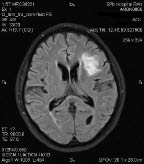 Рис. 1. МРТ головного мозга: инфаркт мозга в «стратегической» для развития когнитивных нарушений зоне