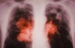 Суд в Туве отправил на принудительное лечение 16 больных туберкулезом