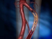 PRAMI: исследование целесообразности профилактической ангиопластики артерий, не связанных с инфарктом, у пациентов с острым инфарктом миокарда с подъемом сегмента ST