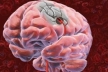 Сульфат магния не обладает нейропротективным действием при инсульте