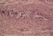Рис. 9. Стенка печеночной артерии с явлениями атеросклероза (скопление пенистых клеток в подслизистом слое), окраска гематоксилином и эозин