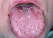 Симптом географического языка, возможно, является проявлением псориаза на слизистой оболочке полости рта