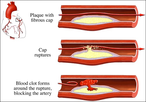 Созревание и разрыв артериальной бляшки, приводящий к возникновению кровяного сгустка — тромба (рисунок Visuals Unlimited / Corbis).