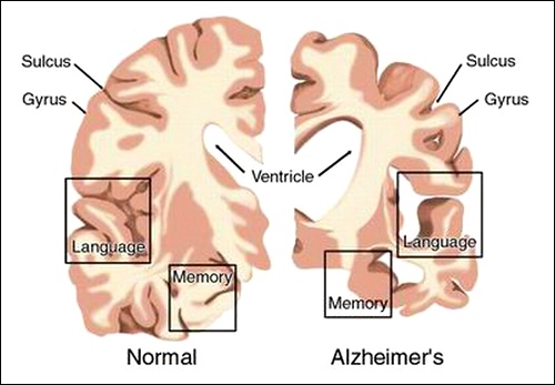 Дегенерация мозговой ткани у больного синдромом Альцгеймера по сравнению со здоровым мозгом. (Фото simplehealthguide)