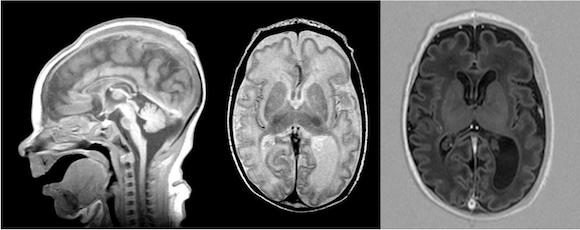 Головной мозг ребенка с генетически обусловненным дефицитом аспарагин-синтетазы