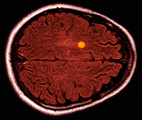 Рассеянный склероз на МРТ; жёлтым пятном выделена зона повреждения белого вещества. (Фото Visuals Unlimited / Corbis)