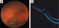 Рис. 2. Офтальмоскопия (A) и томограмма (Б) прогрессирующего невуса хориоидеи