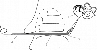 Рис. 1. Схематическое изображение микрокатетера, установленного в устье слуховой трубы (1 – проводник, 2 – микрокатетер, 3 – нижний носовой ход, 4 – устье слуховой трубы,  5 – барабанная полость, 6 – внутреннее ухо)