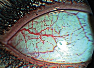 Рис. 3. Биомикроскопия конъюнктивы глаза у беременной с гемоконцентрацией. Увеличение числа капилляров, миандрическая извитость сосудов, нарушение соотношения диаметров артериол и венул