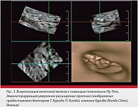Рис. 3. Визуализация молочной железы с помощью технологии Fly Thru, демонстрирующая умеренное расширение протока (изображение предоставлено доктором Т. Курида (T. Kurida), клиника Курида (Kurida Clinic), Япония)