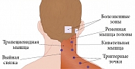 Рис. 1. Типичная локализация триггерных точек и зон максимальной болезненности у пациентов с головной болью напряжения