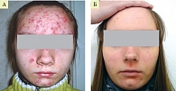 Рис. 3. Пациентка В., страдающая вульгарным акне тяжелой степени,  до лечения (А) и после лечения Акнекутаном (Б)