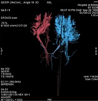 Рис. 8. Трехмерная модель кортикоспинального пути пациентки Д., 67 лет, с острым ишемическим инсультом в бассейне левой средней мозговой артерии