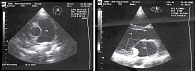 Рис. 3. Допплер-эхокардиограмма пациентки В. в 12 лет: расширение ствола легочной артерии, умеренная дилатация правого и левого желудочка