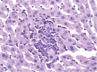 Рис. 5. Скопление макрофагов вокруг погибших гепатоцитов. Окраска гематоксилином и эозином, × 400
