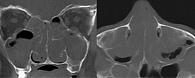 Рис. 2. Компьютерная томография при ХРС с назальным полипозом (полипы полностью заполняют полость носа и все группы околоносовых пазух)