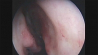 Рис. 2. Нормализация влажности в полости носа, отсутствие слизисто-гнойного отделяемого после лечения