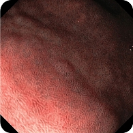 Рис. 6. Н. рylori-положительный тип микрорельефа желудка