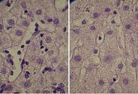 Рис. 3. Плазматические клетки и лимфоциты в просвете синусоидов 