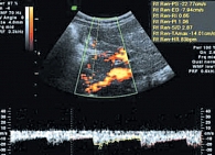 Рис. 12. Артериальный кровоток в мелких артериях поджелудочной железы (режим энергетического картирования и импульсной допплерометрии)