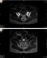 Рис. 10. Магнитно-резонансная томограмма КПС пациента М. исходно (А) (в режиме STIR интенсивность МР-сигнала от костных структур значительно усилена вдоль обоих КПС как со стороны крестца, так и со стороны подвздошных костей) и через семь месяцев (Б)