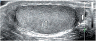 Рис. 3. Эхограмма яичка ребенка 11 лет. Продольное сканирование. 1 – яичко, 2 – головка придатка яичка